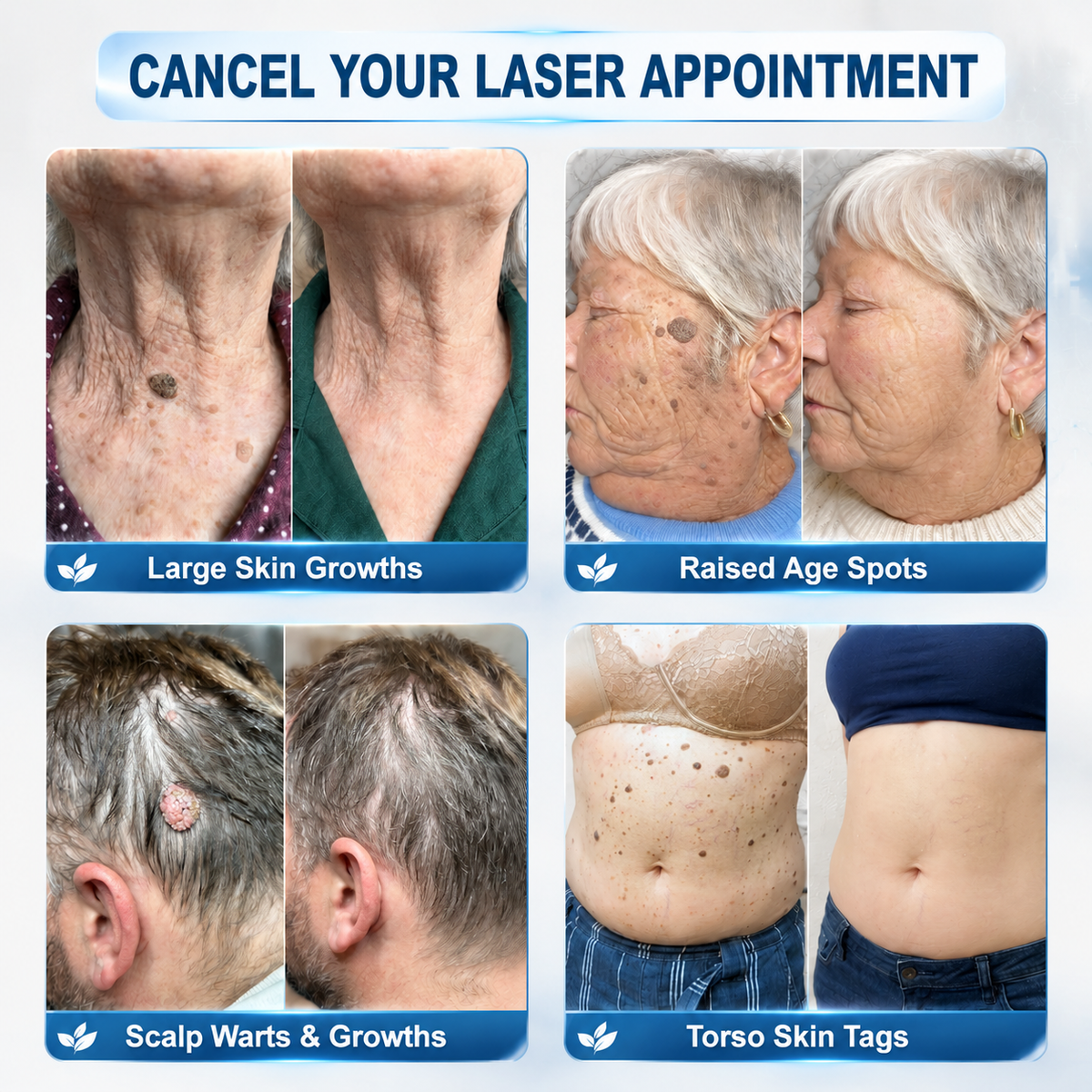 💎💎💎𝐇𝐈𝐒𝐊𝐈𝐍®👩‍⚕️ 𝟕-𝐃𝒂𝘆 𝐒𝗸𝐢𝐧 𝐓𝒂𝗴 & 𝐒𝐩𝙤𝐭 𝐑𝒆𝐦𝙤𝘃𝒂𝐥 𝐒𝐩𝐫𝒂𝘆 Painless & Scar-Free Advanced Imper💎