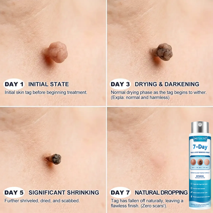 💎💎💎𝐇𝐈𝐒𝐊𝐈𝐍®👩‍⚕️ 𝟕-𝐃𝒂𝘆 𝐒𝗸𝐢𝐧 𝐓𝒂𝗴 & 𝐒𝐩𝙤𝐭 𝐑𝒆𝐦𝙤𝘃𝒂𝐥 𝐒𝐩𝐫𝒂𝘆 Painless & Scar-Free Advanced Imper💎