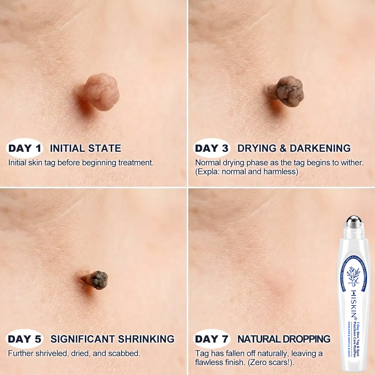 ⭐🎁 𝐇𝐈𝐒𝐊𝐈𝐍® Wart Removal Pen — Only 5 Left! Enjoy an Extra 30% Off Today!A simple, convenient solution for targeted wart care at home. Once they’re gone, this offer won’t return until next year.